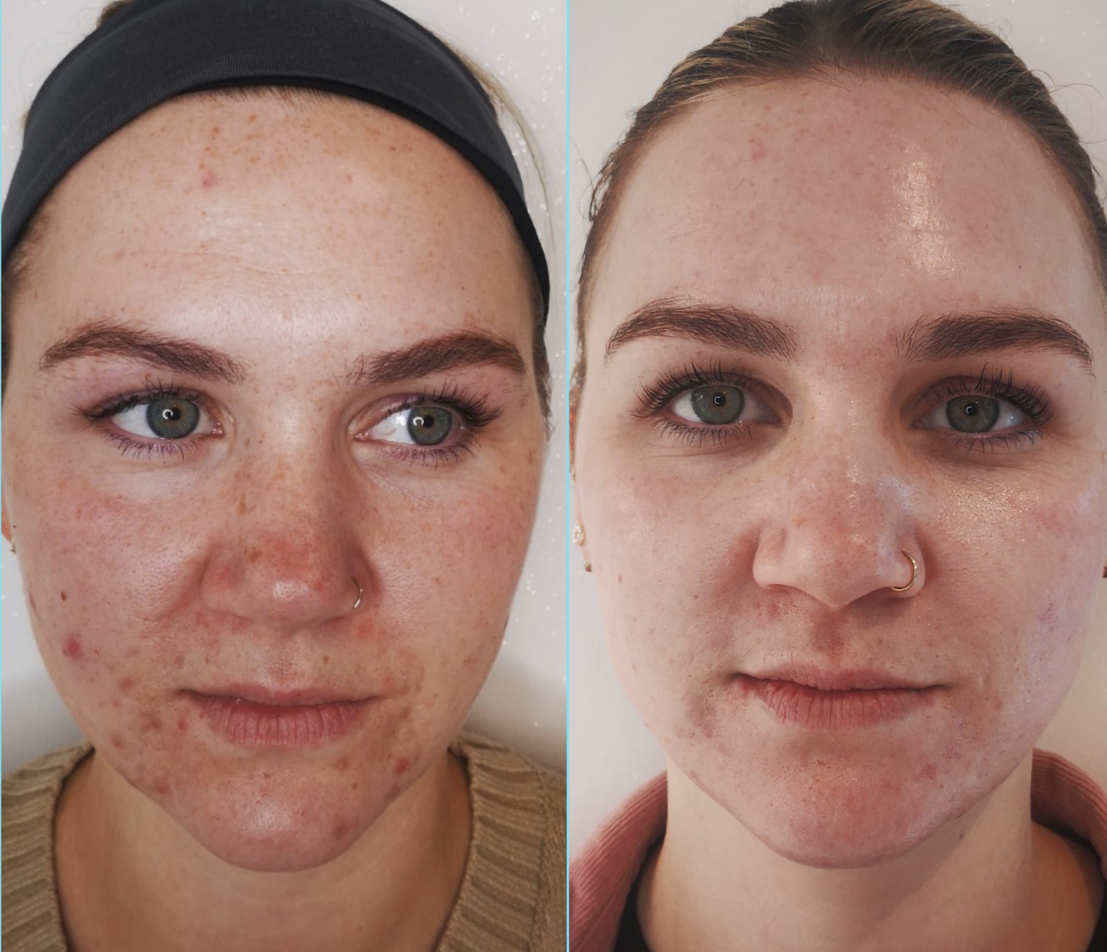 Treatment for Acne and Breakouts