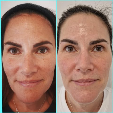 Before and after a Collagen Lift treatment showing improved skin firmness