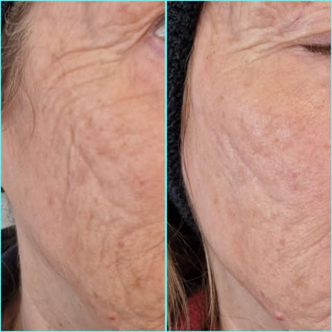 Before and after results showing significant improvement in skin texture and wrinkle reduction