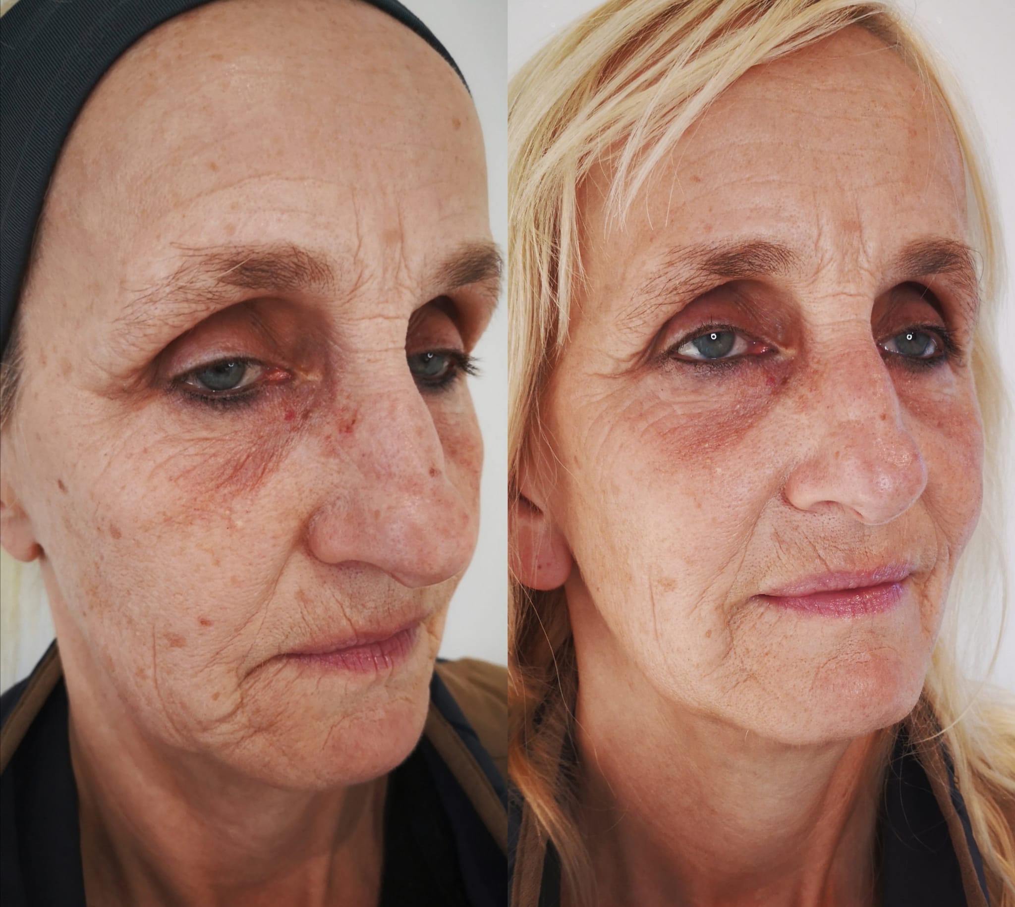 Advanced Skin Treatments