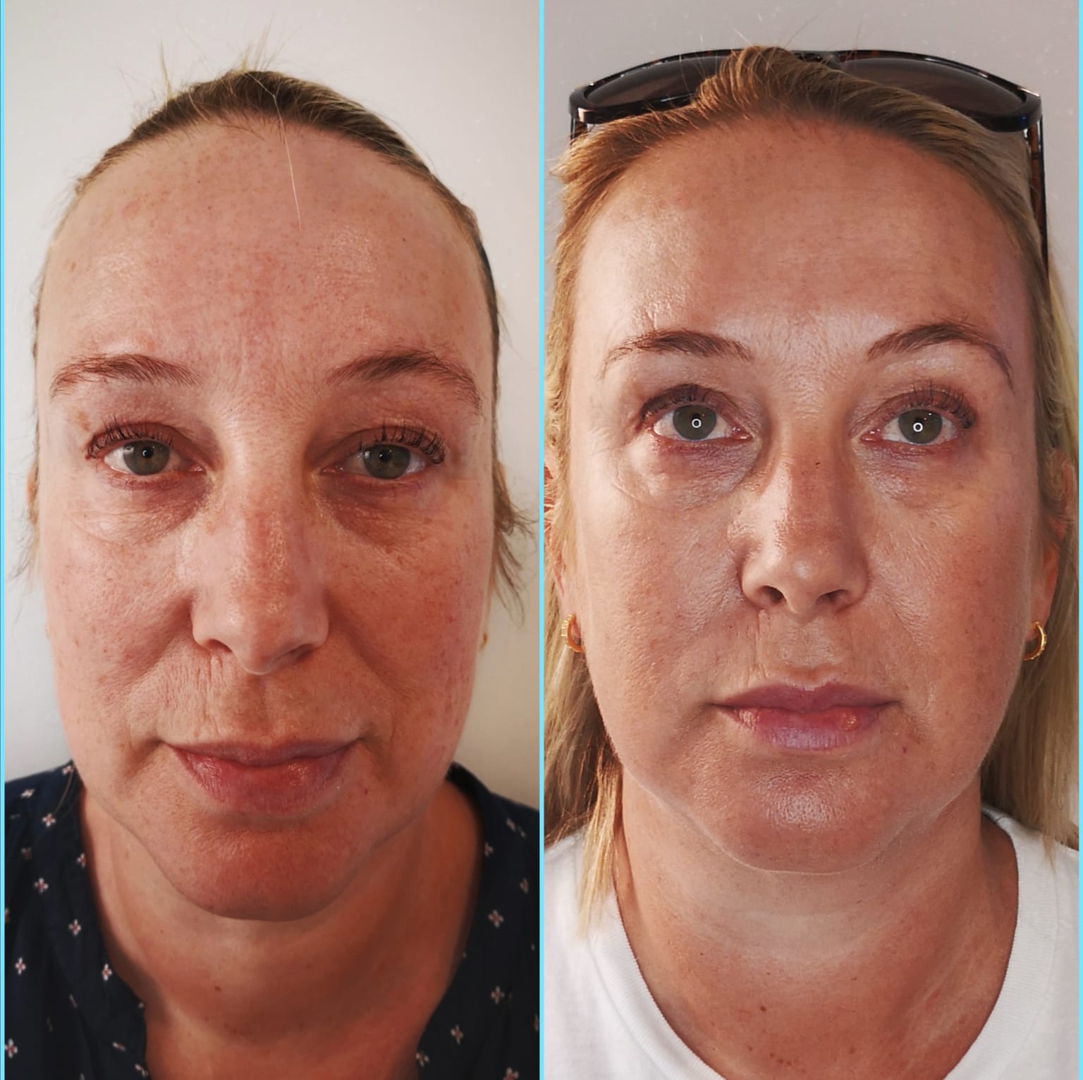 Treatment for Dull, Dehydrated, or Dry Skin