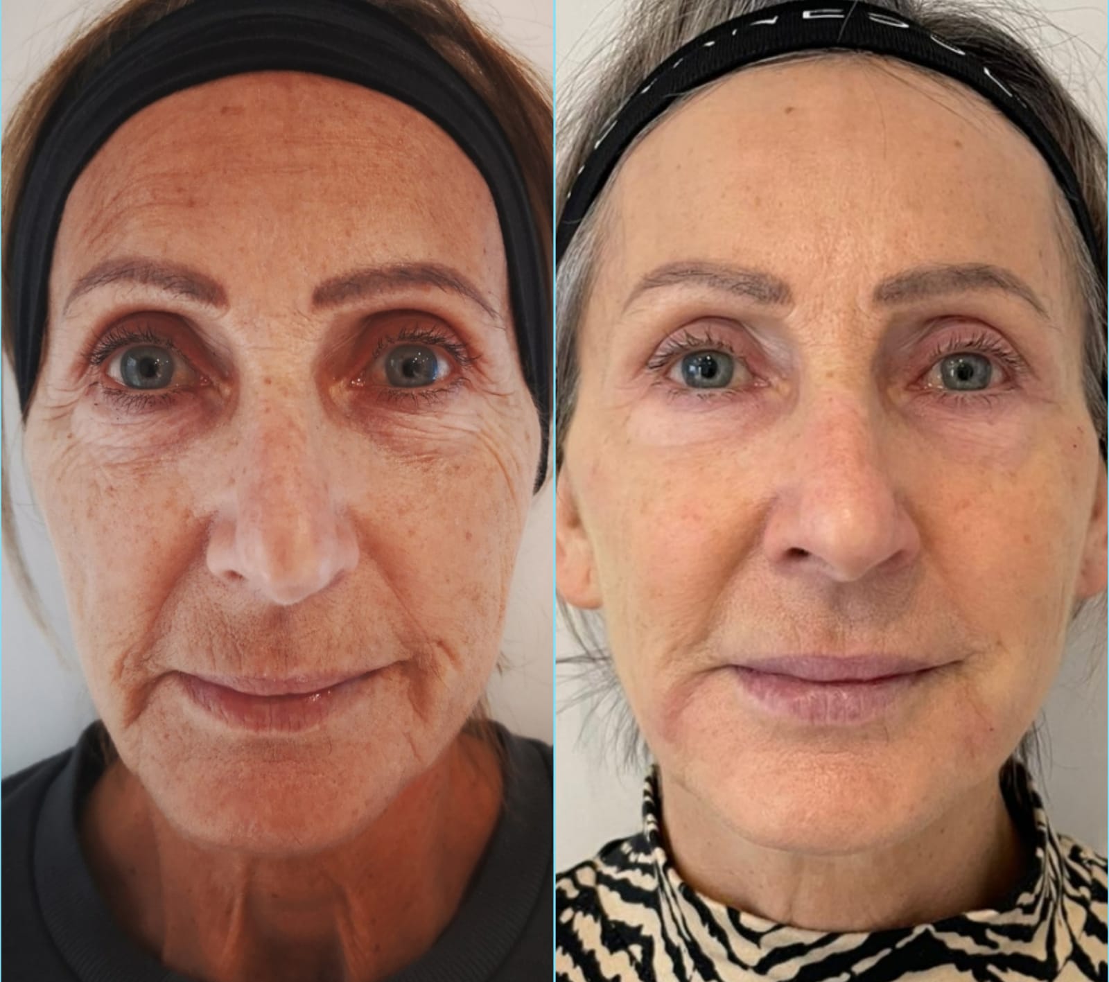 Treatment for Fine Lines & Wrinkles