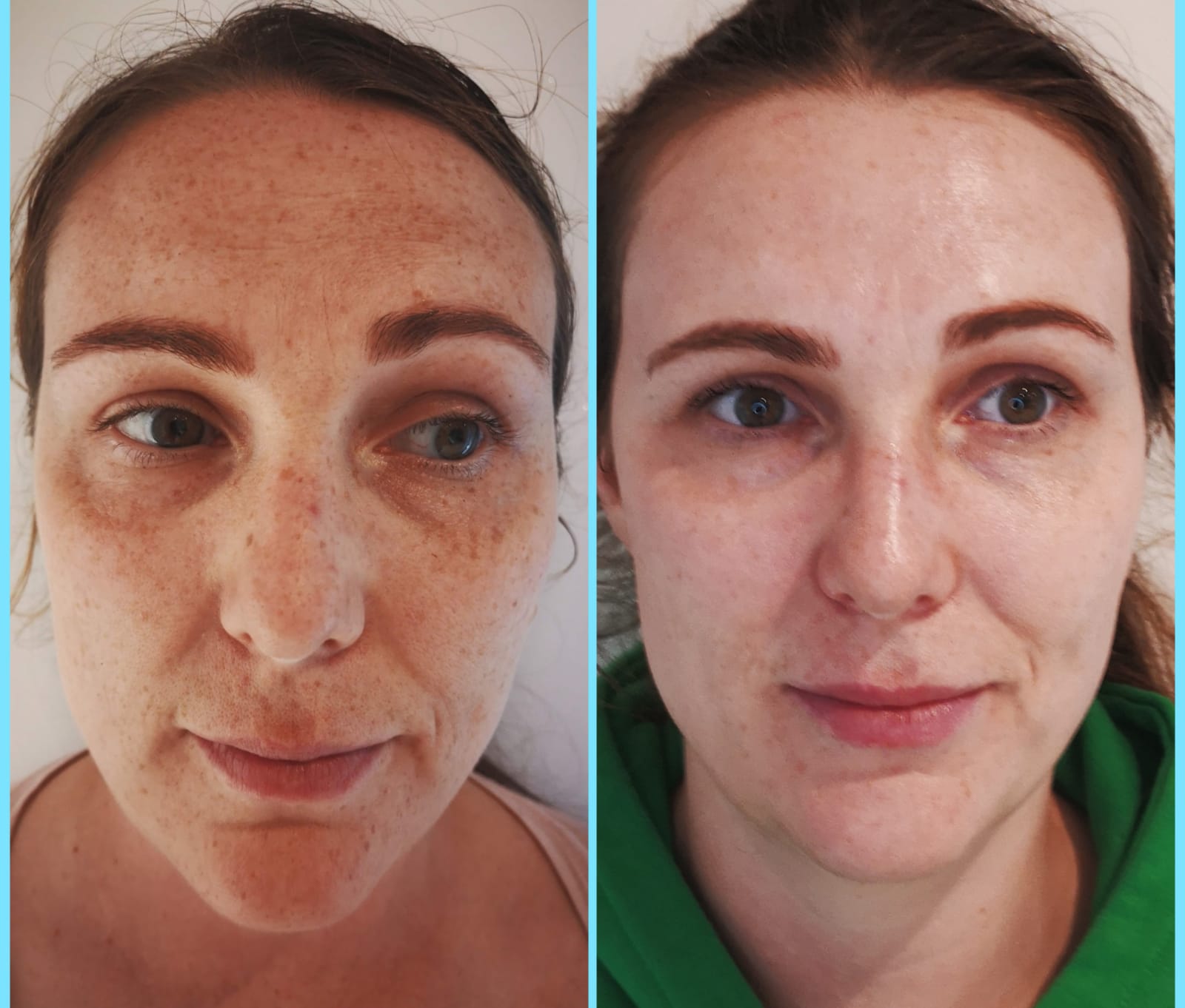 Treatment for Uneven Tone, Pigmentation, Sun Damage