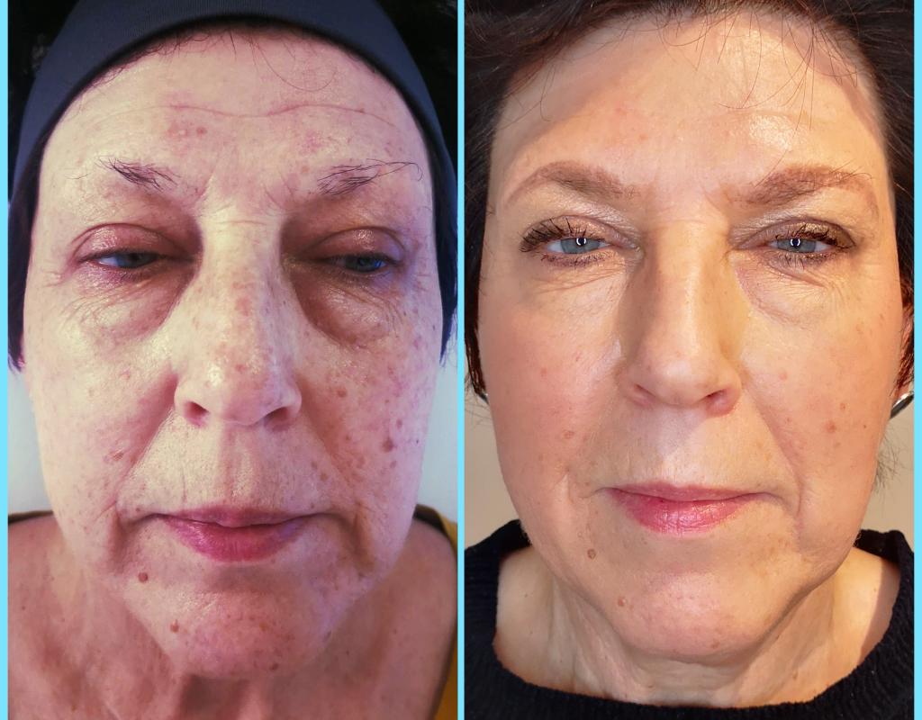 Treatment for Lax, Sagging Skin