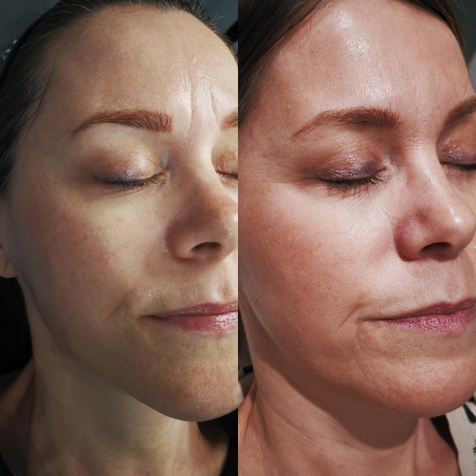 Before and after Medical Microneedling showing reduction in acne scarring
