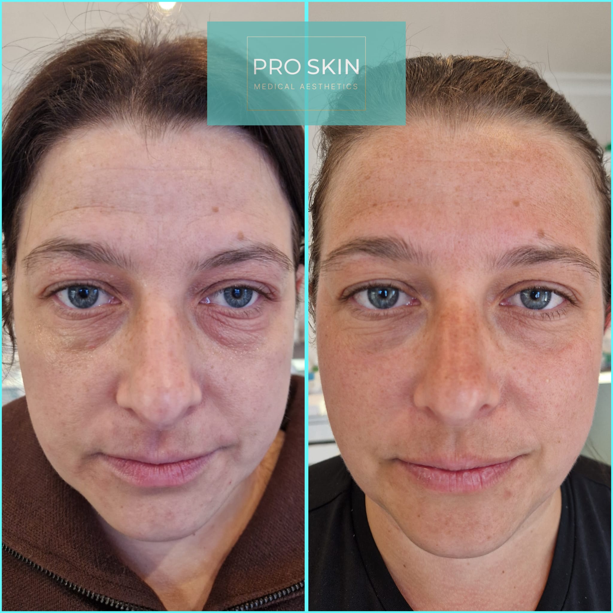 Dermalux LED light therapy session