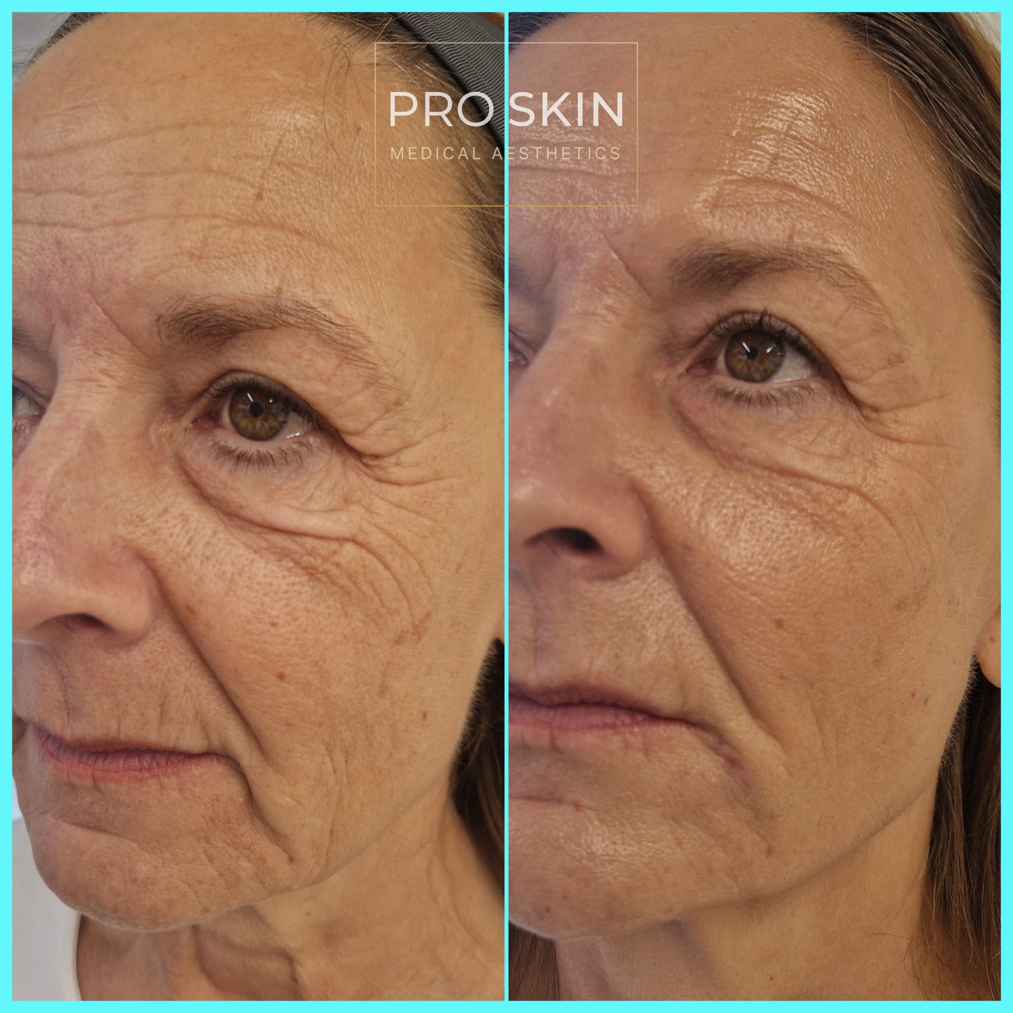 This patient received full-face dermal filler rejuvenation