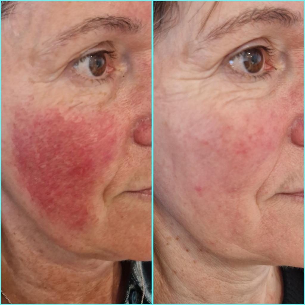 Treatment for Redness, Rosacea, Sensitivity
