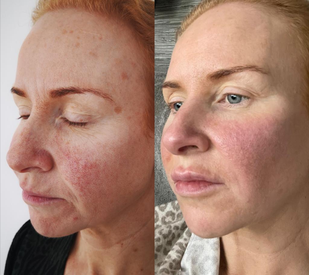 Before and after dermal filler treatment showing restored volume in the cheeks