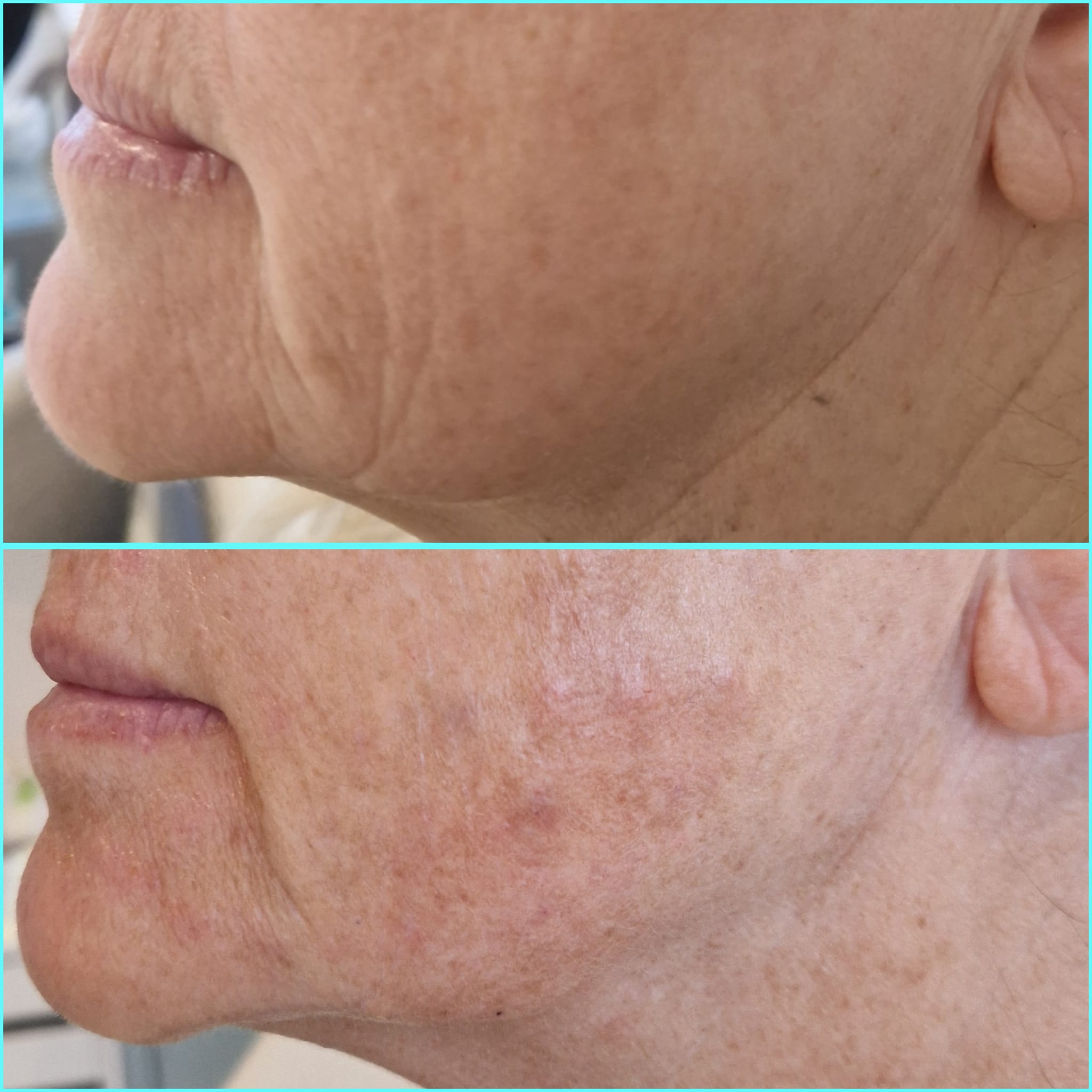 Before and after polynucleotide treatment showing improved under-eye skin texture
