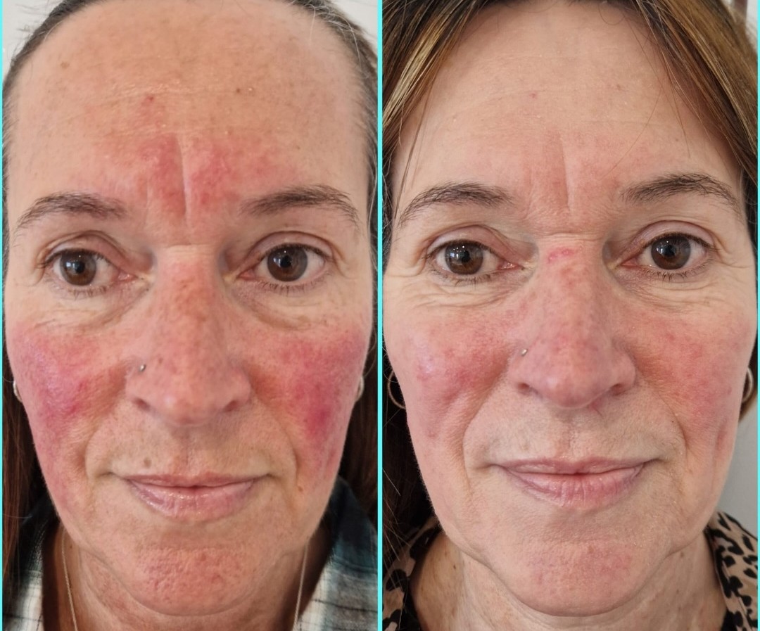 This patient, after battling rosacea for years, had a prescriptive skincare routine, Dermalux treatments, and IPL