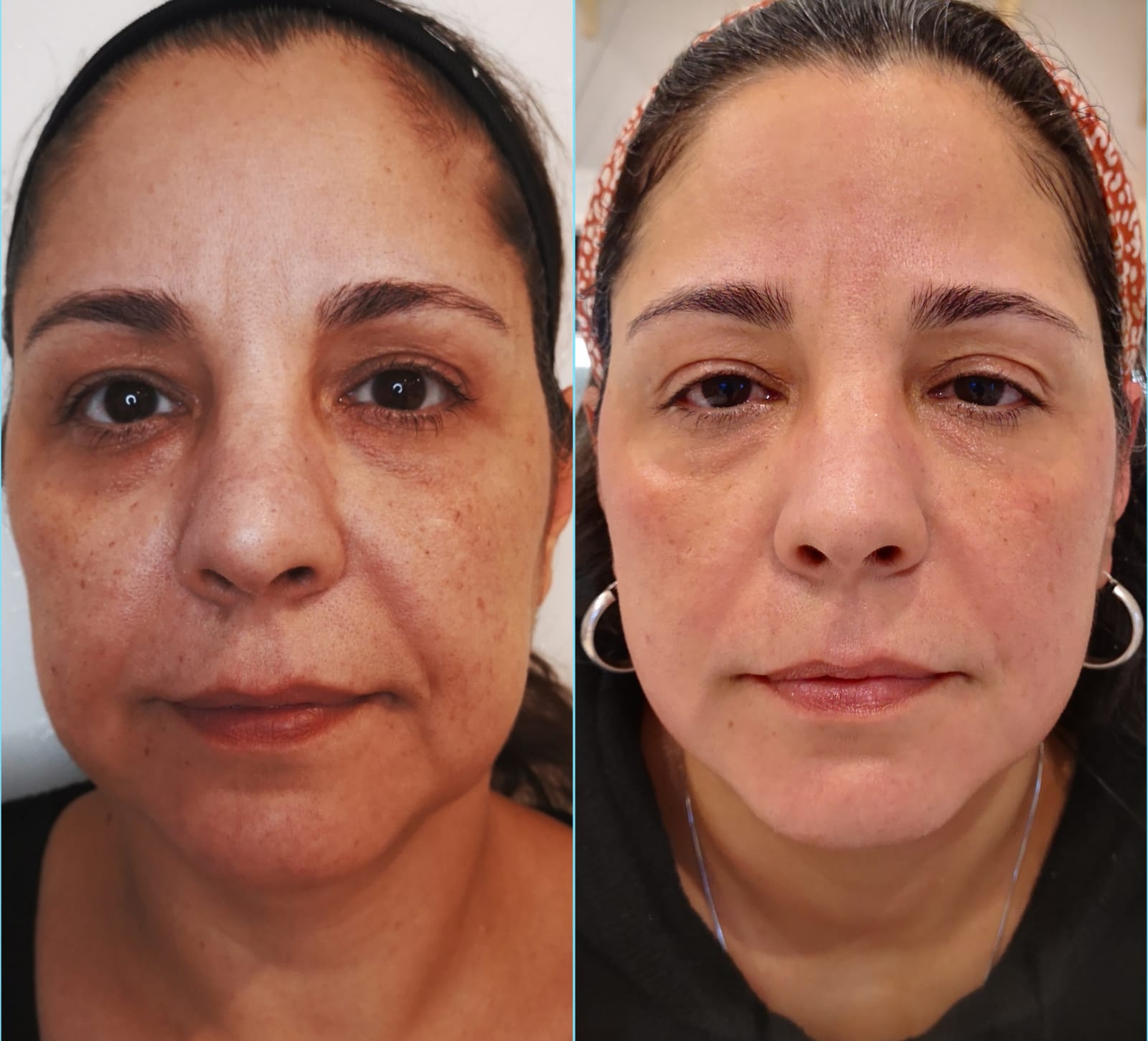 Reduction in freckles and sun damage