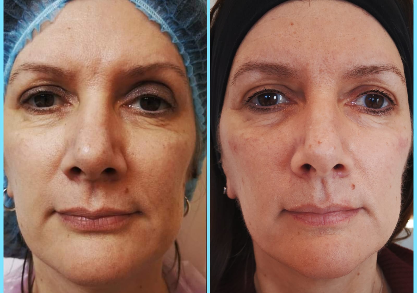 Before and after Profhilo treatment showing improved skin texture and hydration