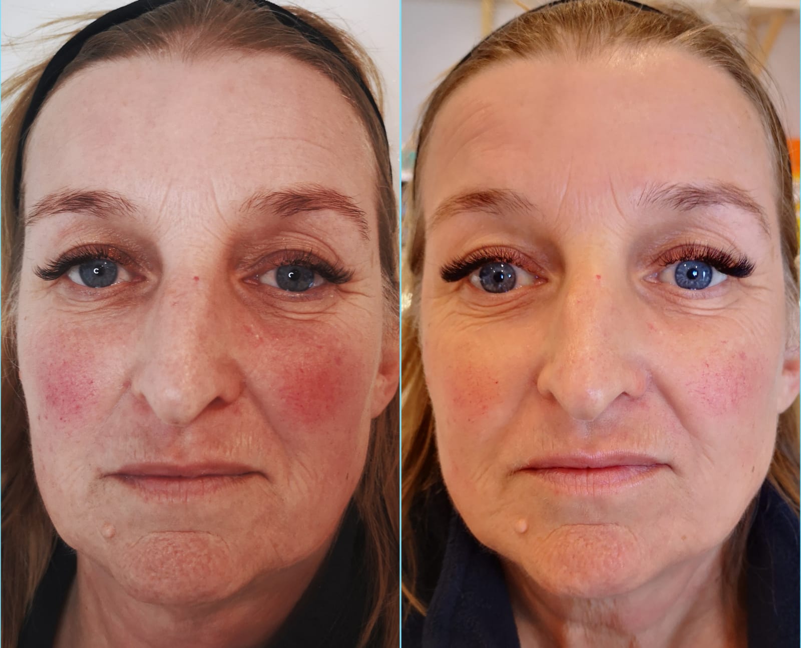 Reduction in facial redness and rosacea