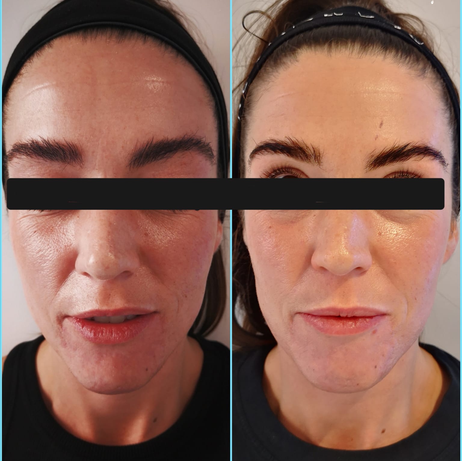 Injectables & Skin Boosters