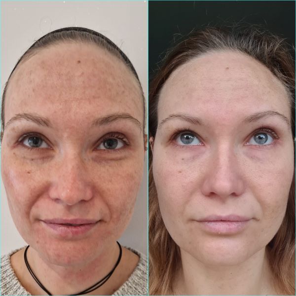 Before and after a teen facial showing clearer skin